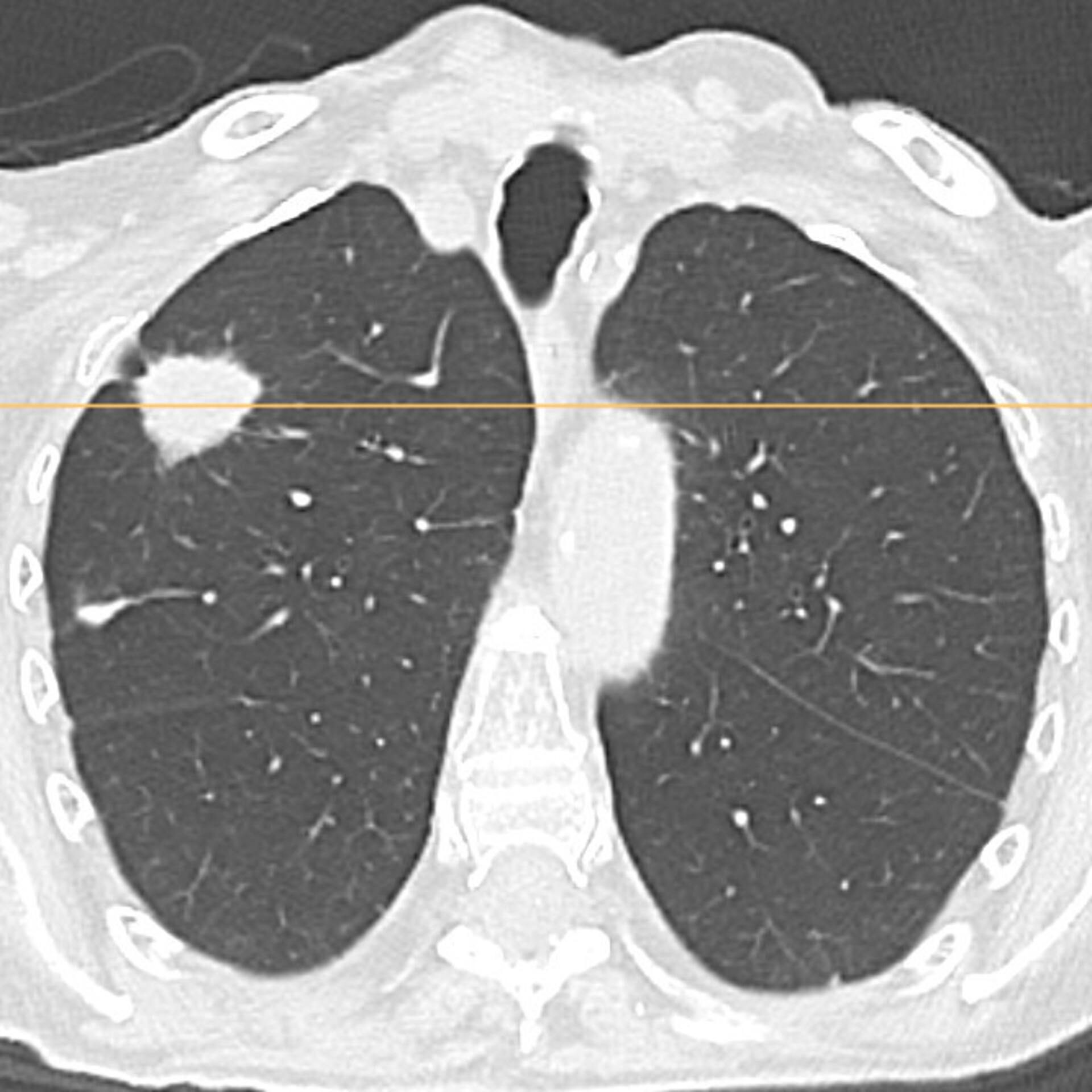 Lungenkrebsscreening - Früherkennung mit Niedrigdosis-CT